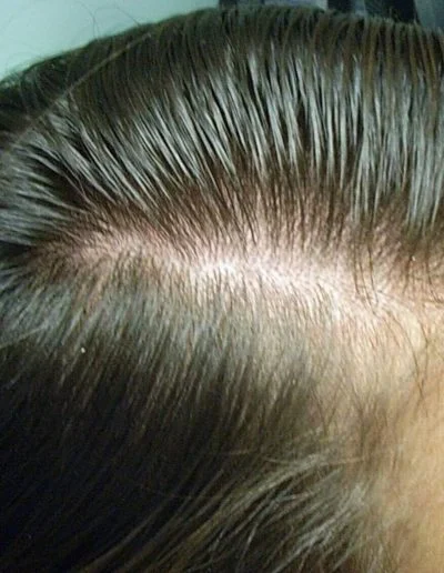 8 Annas Female Pattern Balding Pre Treatment