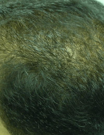 Ni Male Pattern Baldness — After