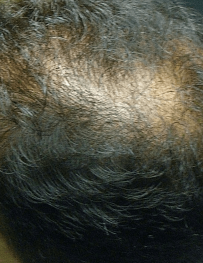 Ni Male Pattern Baldness — Before