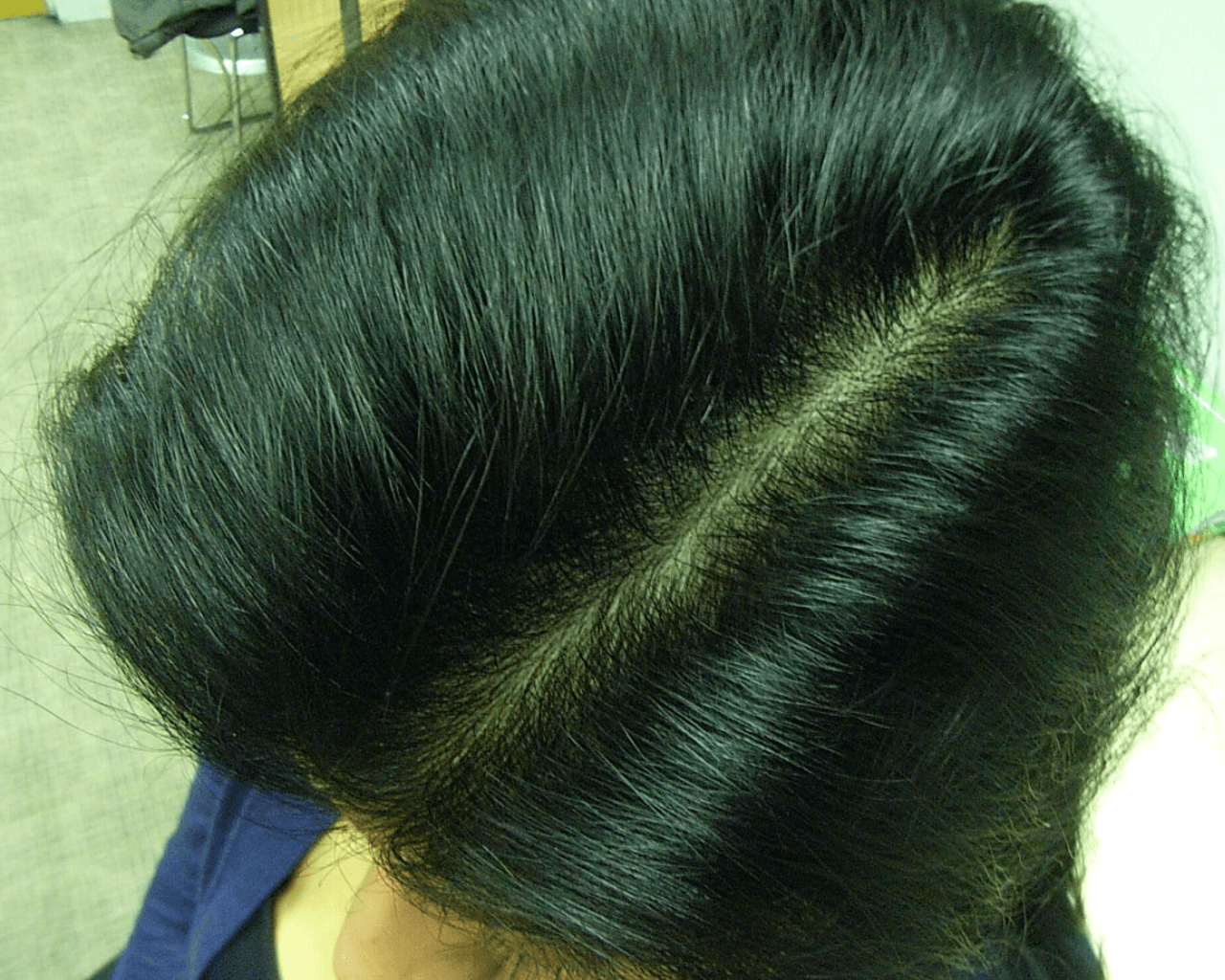 Diane after treatment — Alopecia Areata