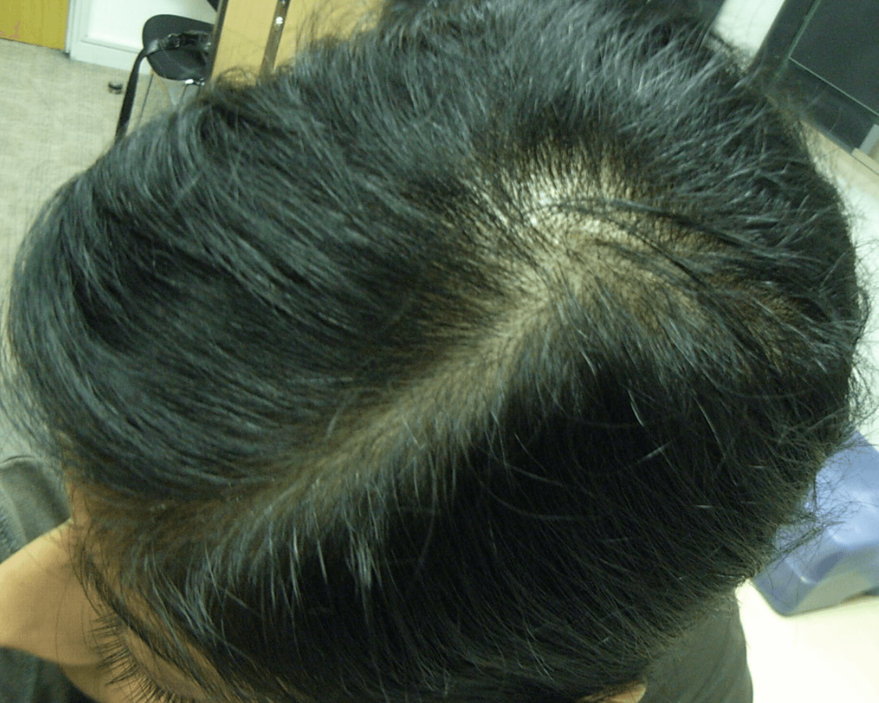 Diane before treatment — Alopecia Areata