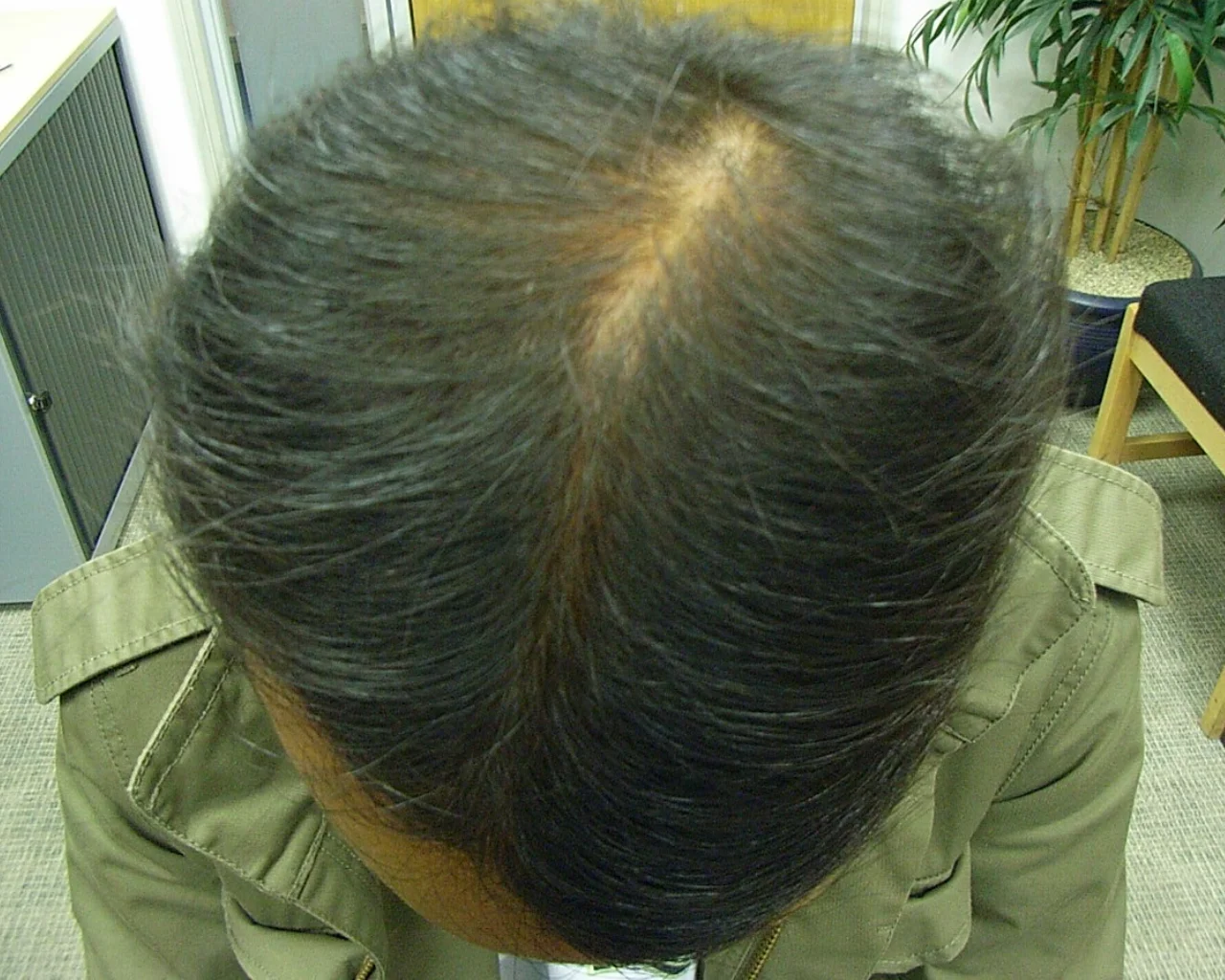Asim Male Asian Hair Loss Post Treatment