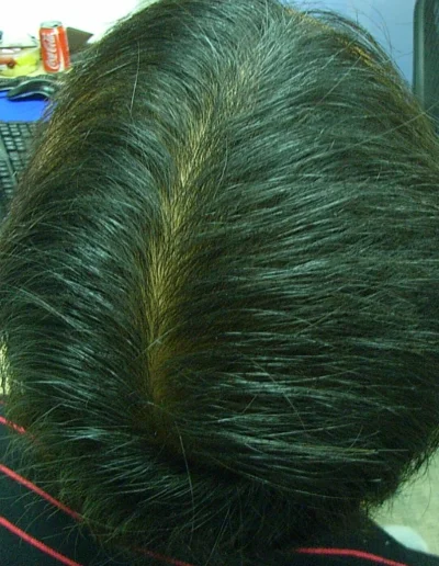 Male Asian Hair Loss Post Treatment
