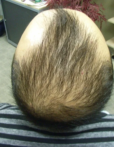Male Asian Hair Loss Pre Treatment