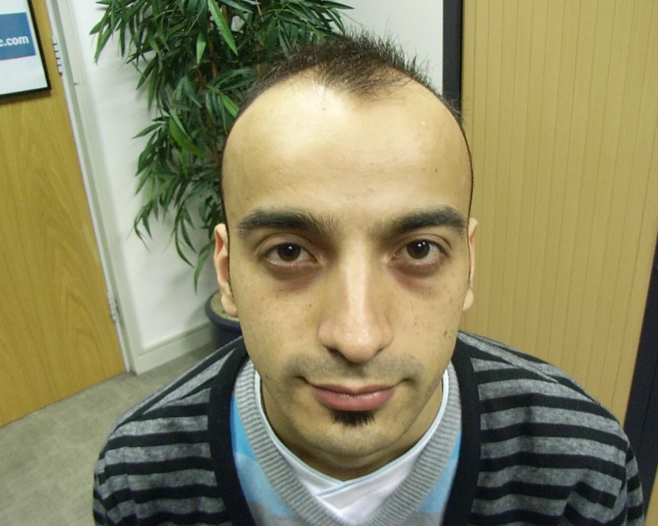 Asim Male Asian Hair Loss Pre Treatment