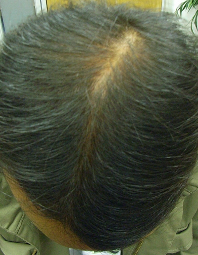 Asim Male Pattern Baldness — After