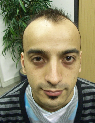 Asim Male Pattern Baldness — Before