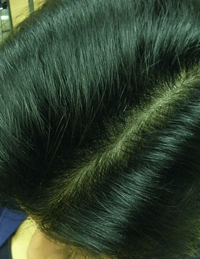 Bally — Female Pattern Balding after treatment