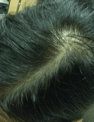 Bally — Female Pattern Balding before treatment