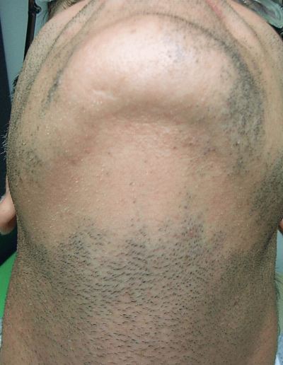 Stephen before treatment — Alopecia Barbae