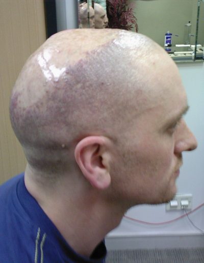 Darren after treatment — Folliculitis Decalvans