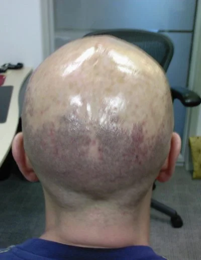 Darren Successful Follicultis Declavans Treatment 2