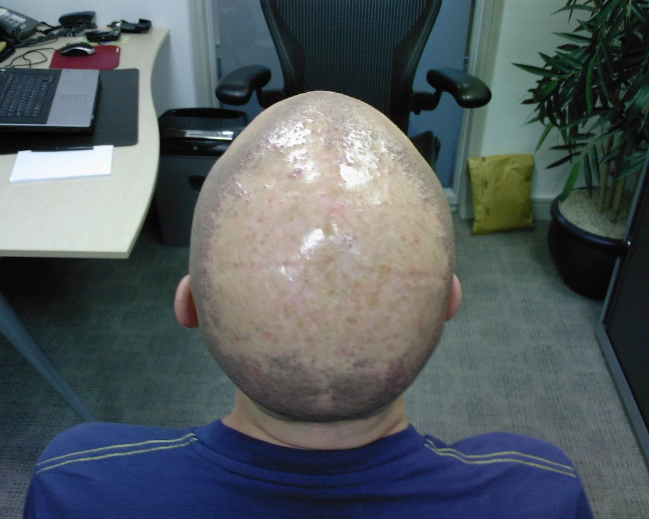 Darren Successful Follicultis Declavans Treatment