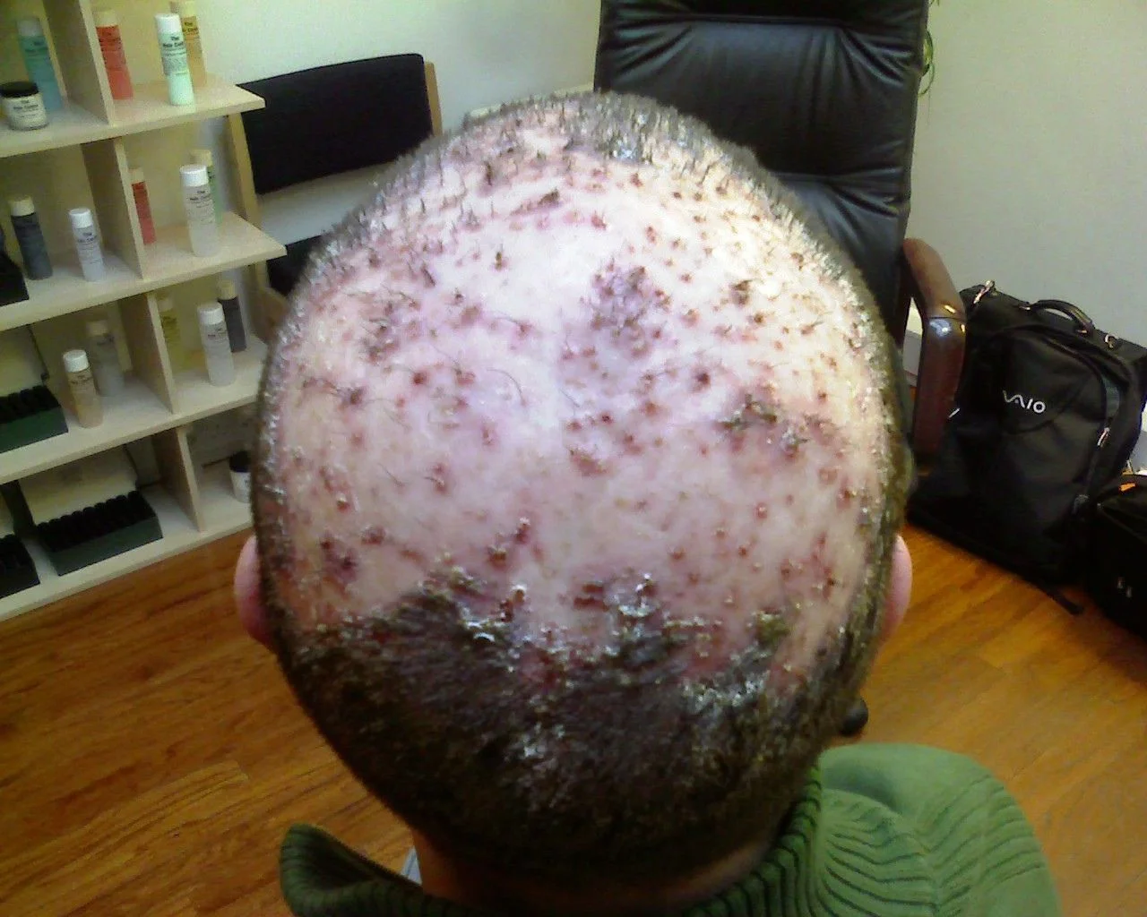 Darren Severe Follicultis Declavans Pre Treatment