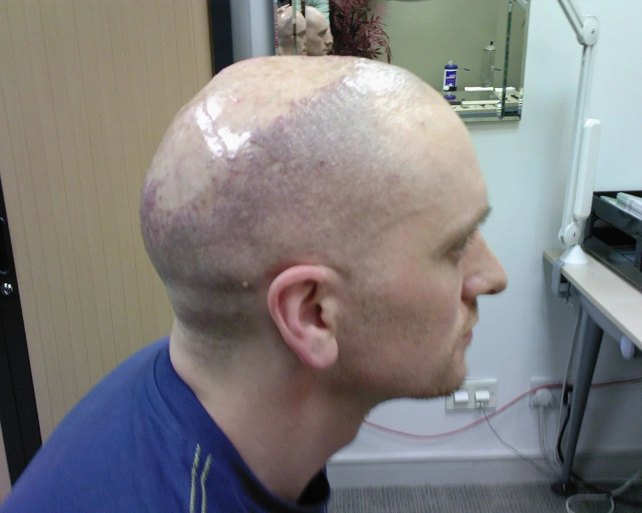 Darren Cured Follicultis Declavans Post Treatment Picture