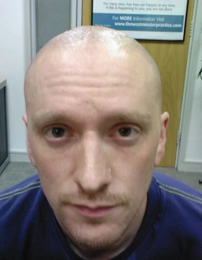 Darren Cured Follicultis Declavans Picture