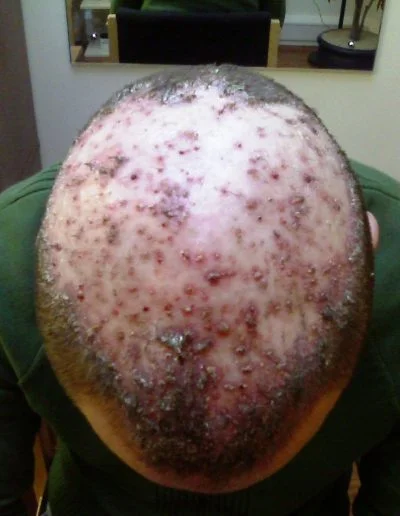 Follicultis Declavans Pre Treatment