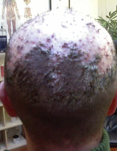 Male Severe Follicultis Declavans Pre Treatment