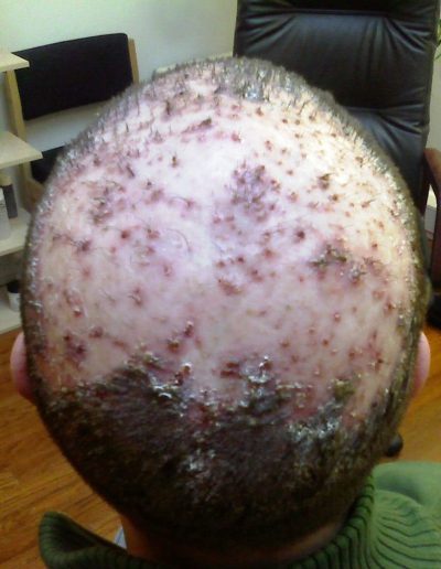 Darren before treatment — Folliculitis Decalvans