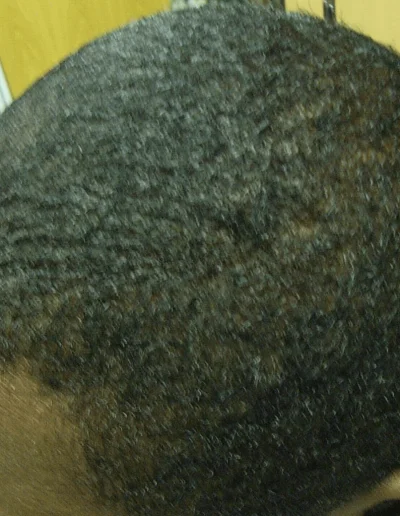 Young Black Man Baldness Treated