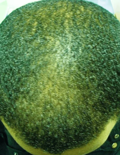 Black Male Patern Baldness