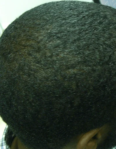 Black Male Pattern Baldness Recovery