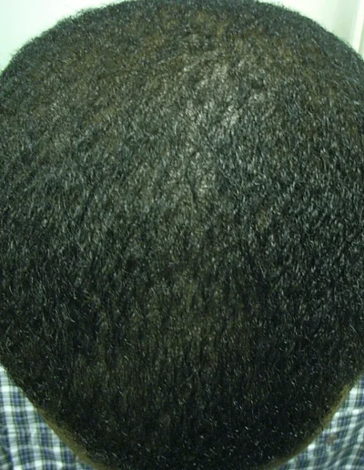 Black Male Hair Loss Recovery