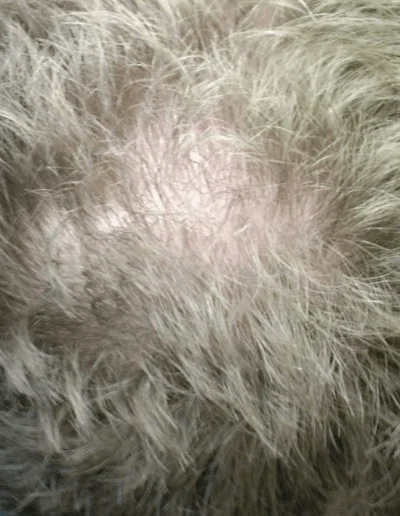 David Crown Hair Recovery — Before