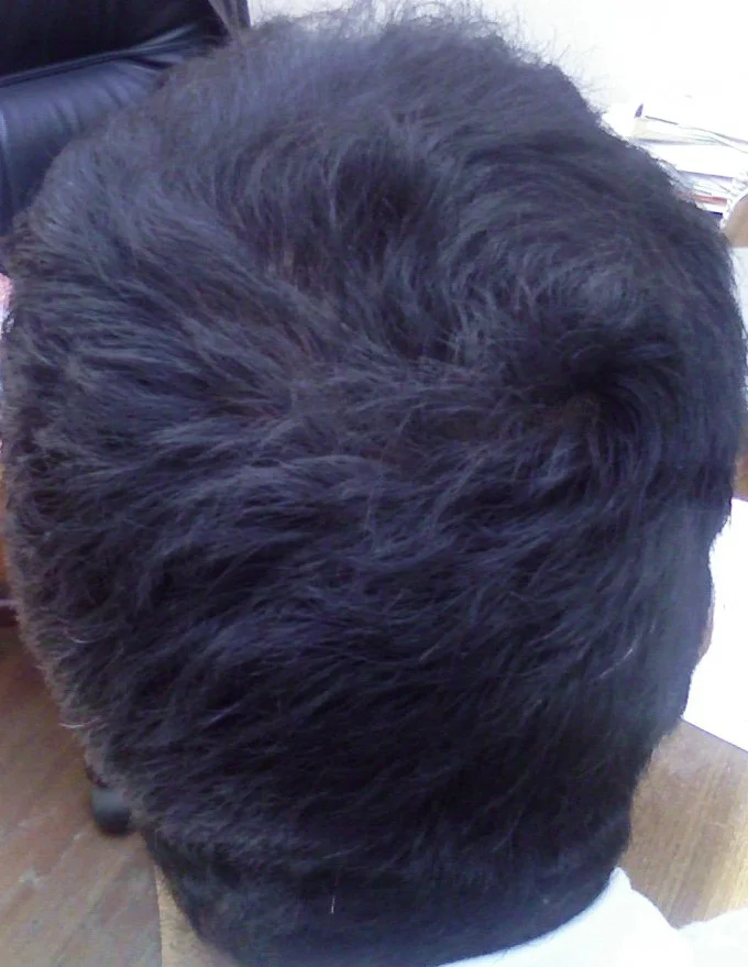 David after male pattern baldness treatment results