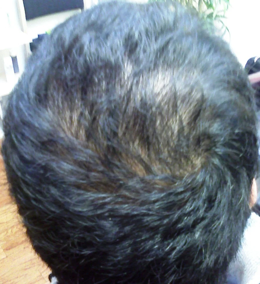 David before male pattern baldness treatment at The Hair Centre