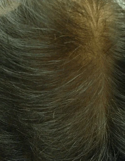 Doreen after telogen effluvium treatment