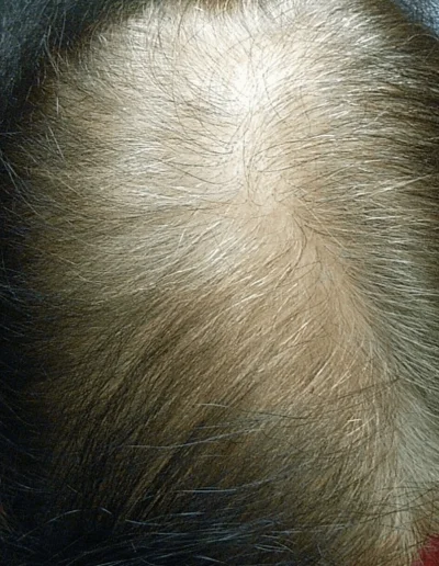 Doreen before telogen effluvium treatment