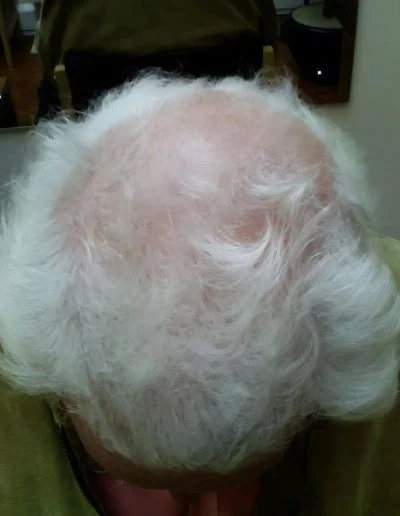 Giovanni Pre Treatment 2