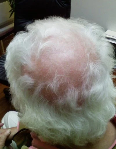 Giovanni Pre Treatment 1