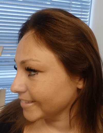 Hanna Diffuse Thinning Post Treatment