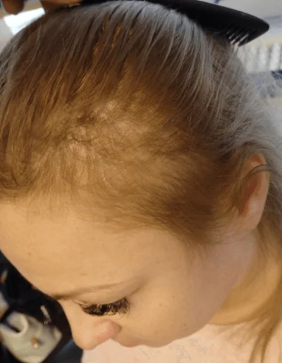 Hanna Diffuse Thinning Pre Treatment