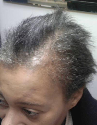 Hazel Traction Alopecia — Before