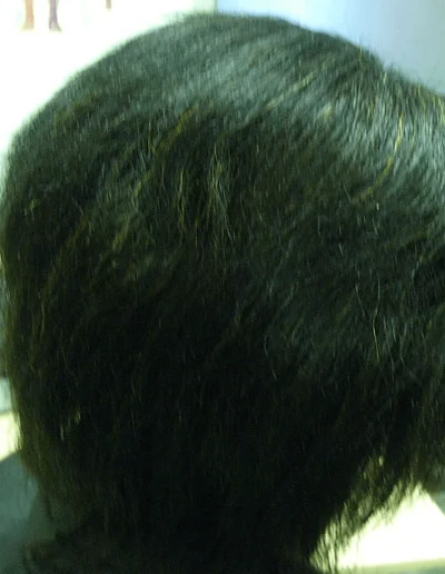 Hazel — Traction Alopecia after treatment