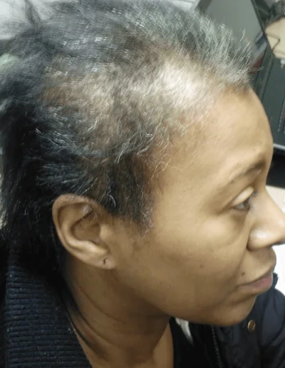 Hazel — Traction Alopecia before treatment