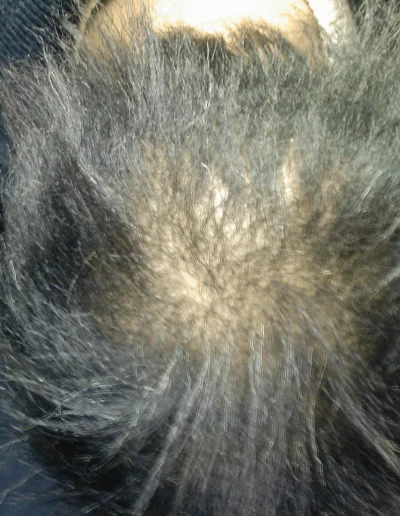 Hazel Traction Alopecia Black Hair Loss