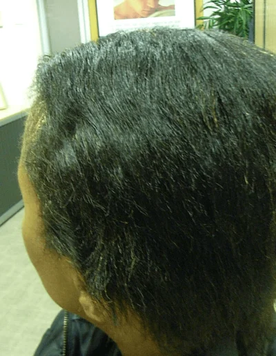 Black Female Hair Loss Full Recovery