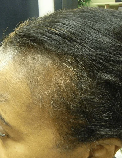 Hazel Black Hair Loss Recvery After 14 Months