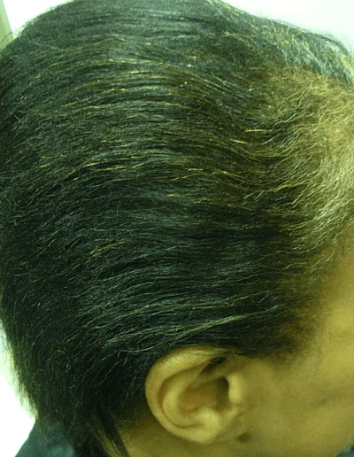 Hazel Black Hair Loss Recovery Story