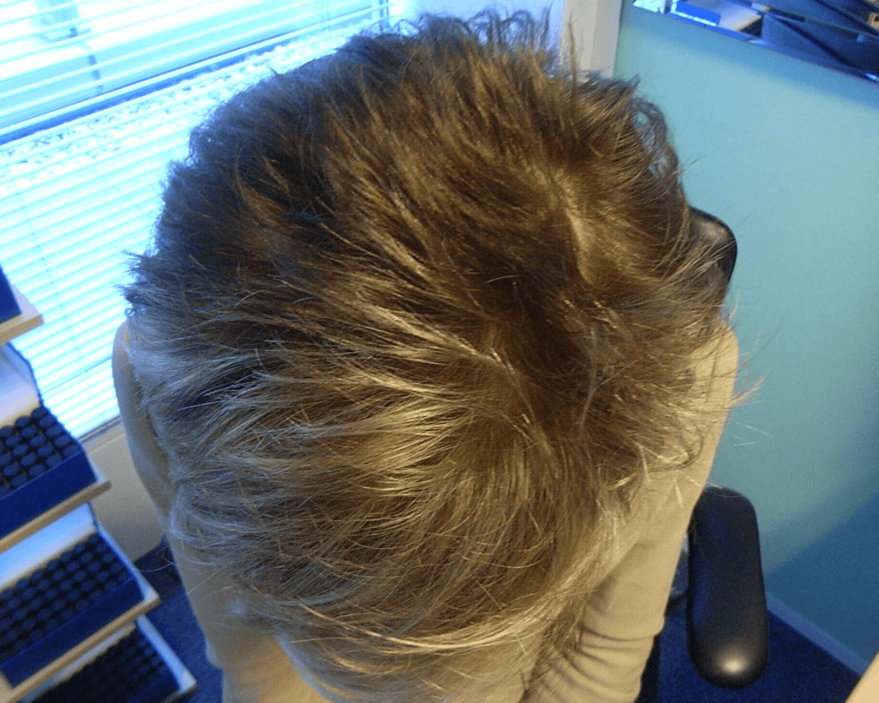 Helen Female Pattern Balding & Telogen Effluvium — After
