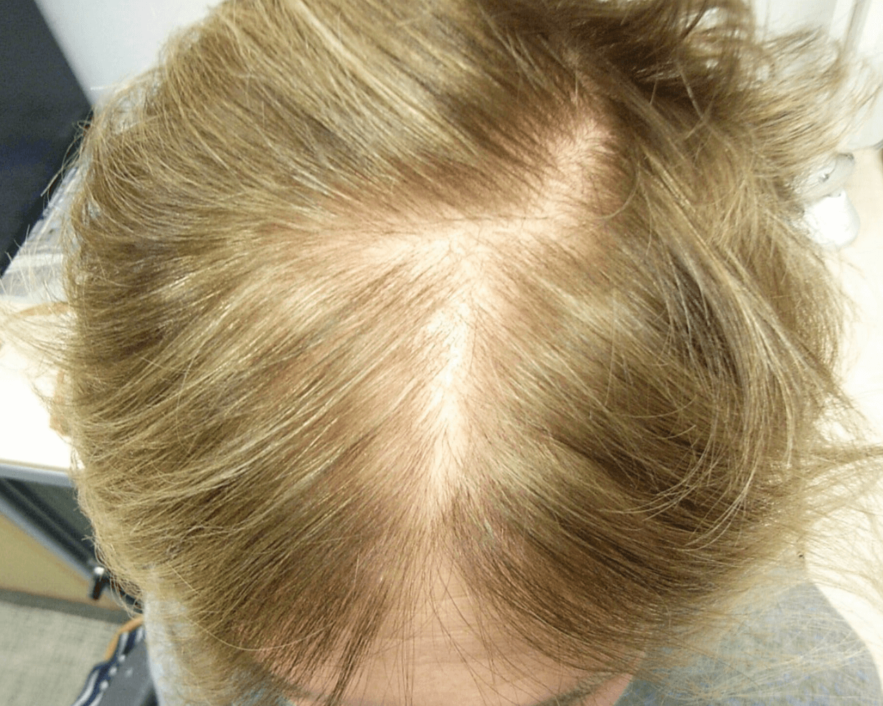 Helen Female Pattern Balding & Telogen Effluvium — Before