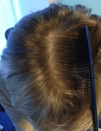 Helen Menopause Hair Loss 50S During Treatment