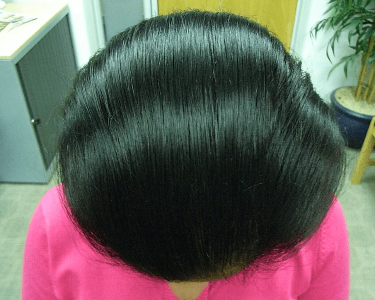 Jazz Androgenetic Alopecia Recovery