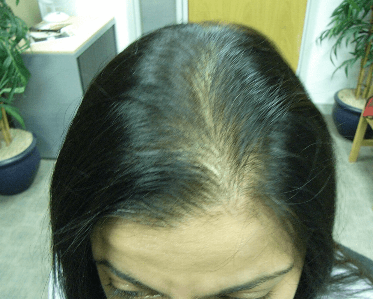 Jazz before treatment — Female Pattern Balding