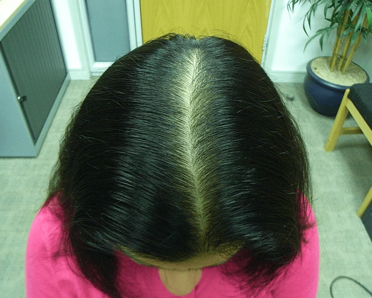 Jazz Androgenetic Alopecia Successful Treatment