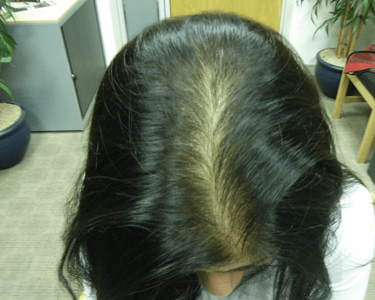 Jazz Hair Loss Before